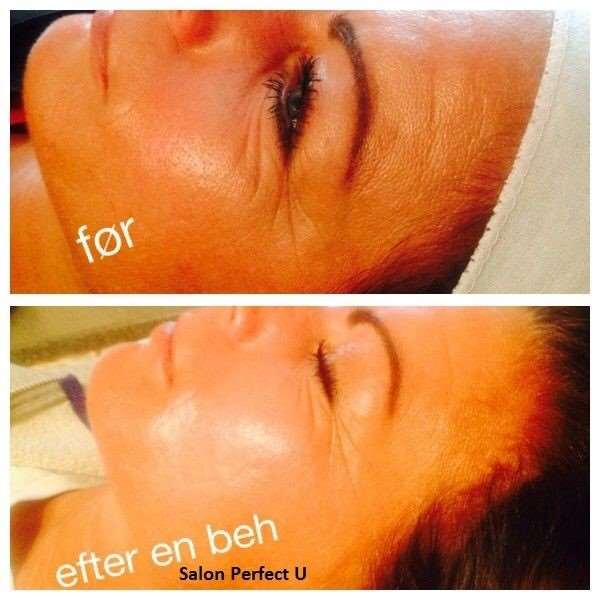 Før og efter billeder med SkinPen behandling 