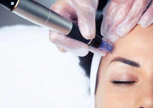SkinPen behandling hjælper bland andet på rynker